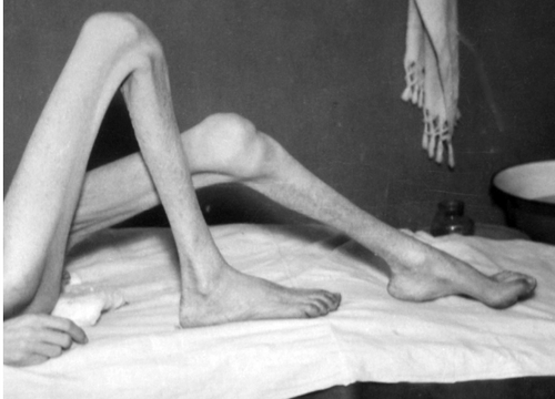 Wychudzone nogi więźniarki KL Auschwitz Betty Spinozy, obywatelki holenderskiej narodowości żydowskiej, po wyzwoleniu przebywającej w szpitalu obozowym mieszczącym się w bloku 14 obozu macierzystego, maj 1945 r. (fot. IPN)