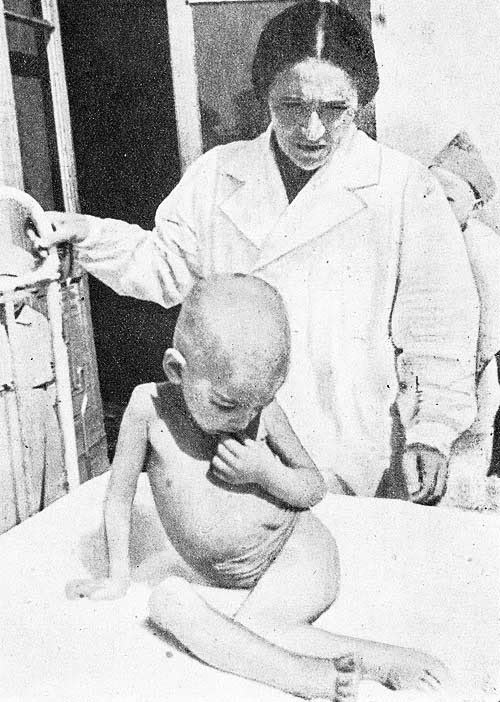 Anna Braude-Heller w czasie badań klinicznych nad głodem w getcie warszawskim w 1942 r. Na zdjęciu z nieznanym dzieckiem cierpiącym na spowodowaną głodem puchlinę brzuszną i trwały przykurcz zginaczy ud i podudzi. Fotografia z: „Choroba głodowa. Badania kliniczne nad głodem wykonane w getcie warszawskim z roku 1942”, red. Emil Apfelbaum, Warszawa 1946 (domena publiczna)